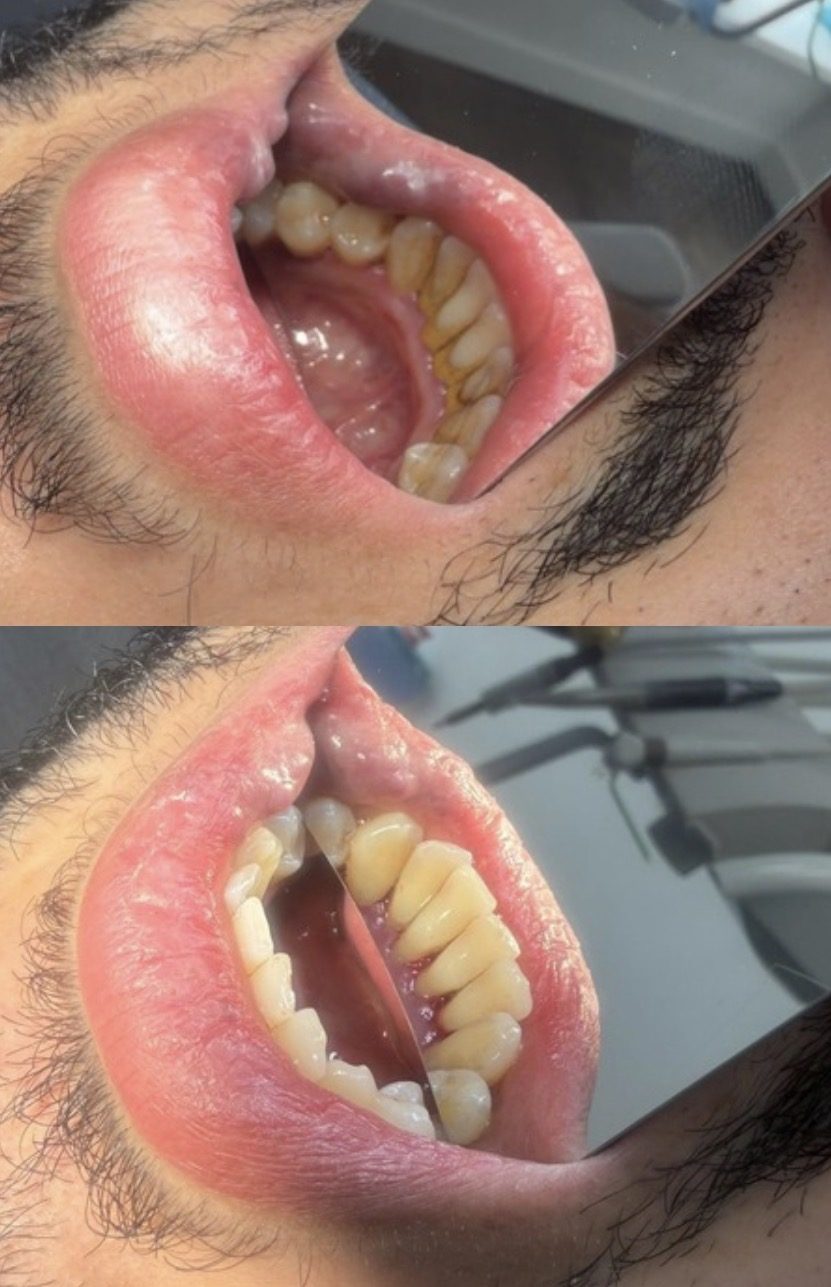 Voor en na een bleekbehandeling bij Happy Smile Dordrecht