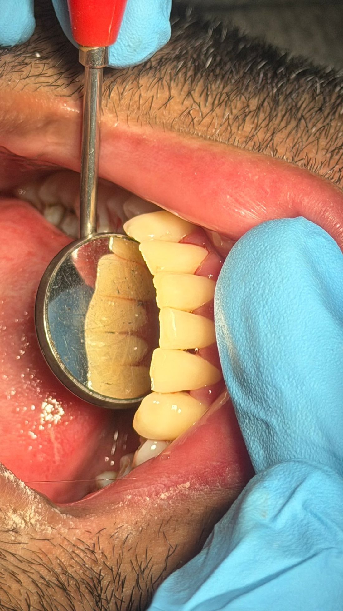 Professionele gebitsreiniging bij Happy Smile Dordrecht