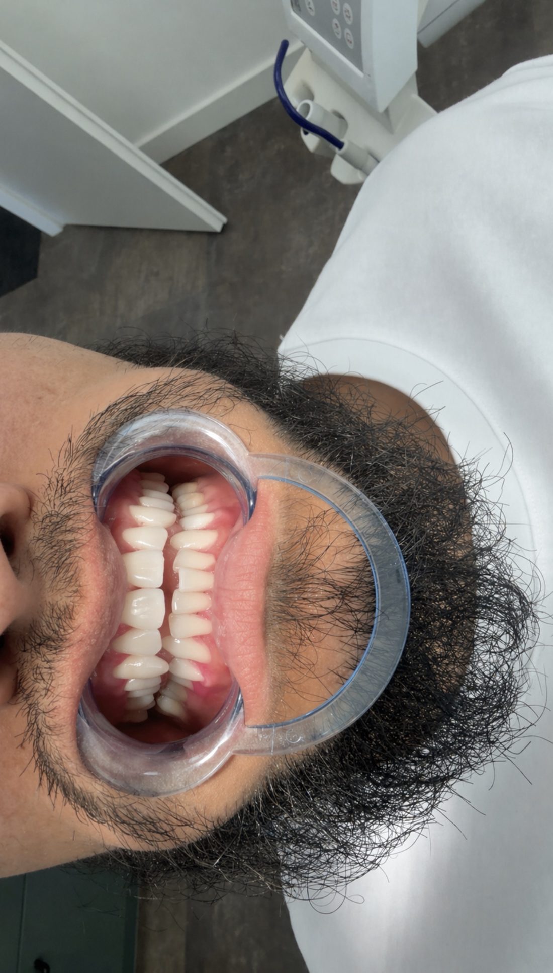 Resultaat van een bleekbehandeling bij Happy Smile Dordrecht